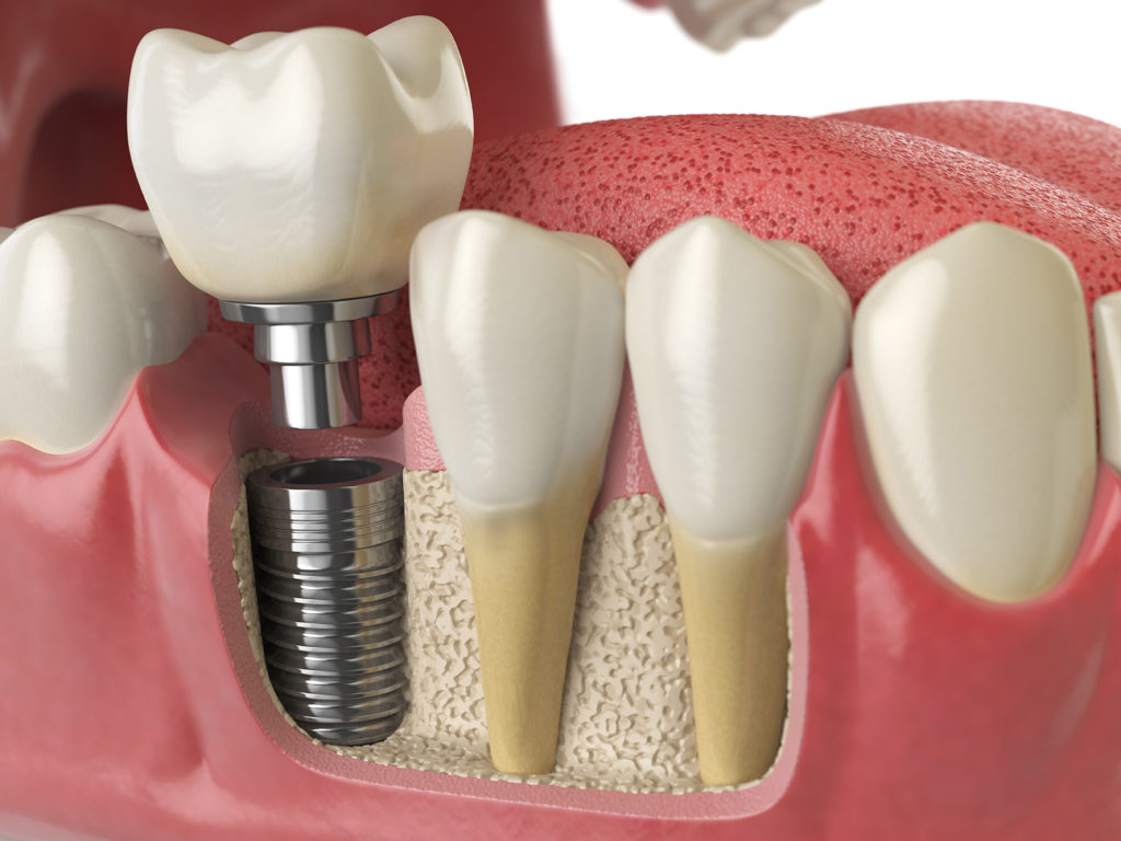 model of a placed dental implant