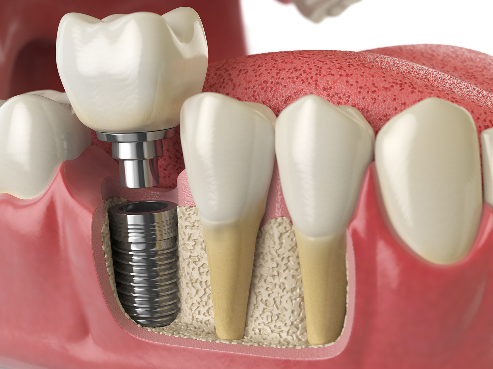 Se puede reparar una prótesis dental fija