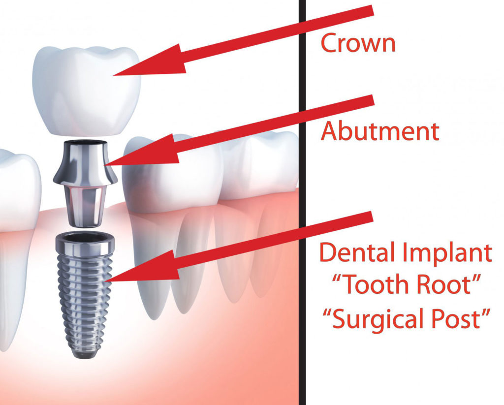 Dental Implant Model Showing off The Different Parts Of A Dental Implant