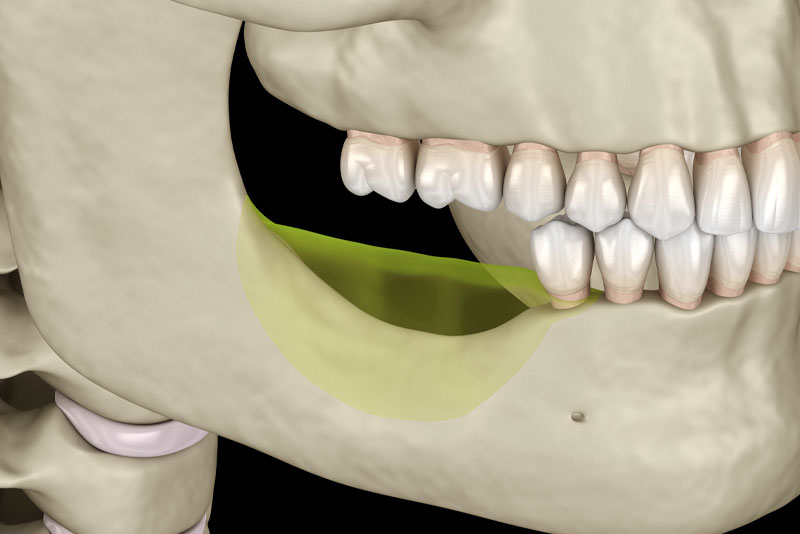 Dental Patient With Jawbone Loss After A Tooth Extraction
