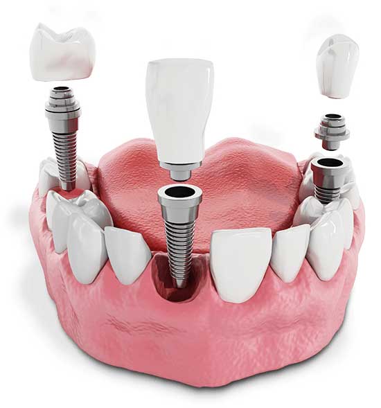 model with multiple dental implants being placed