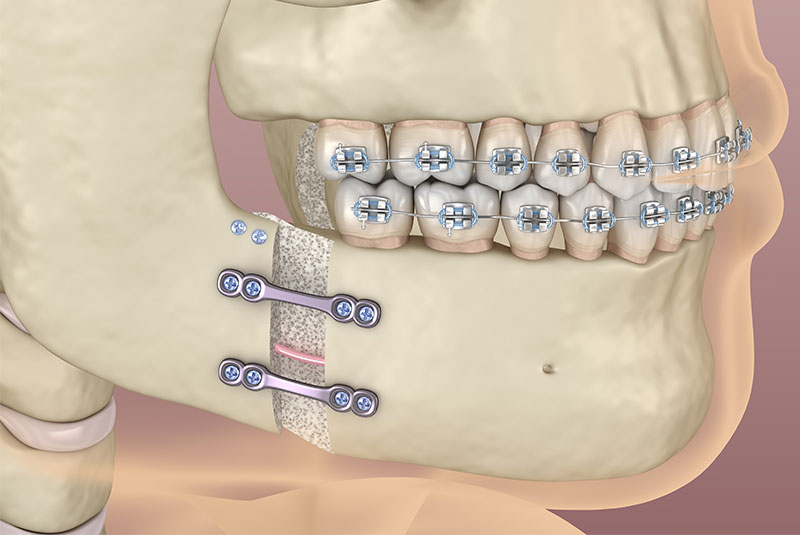 orthognathic surgery