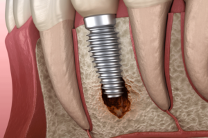 a single dental implant being affected by peri-implantiits