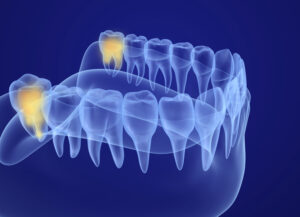 Wisdom tooth xray view. Medically accurate tooth 3D illustration