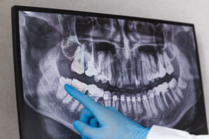 an image of an impacted wisdom tooth.