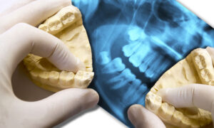 Dentist holding two jaw models at the wisdom tooth position with a Xray in the background