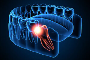 wisdom tooth visualization showing a wisdom tooth impacting a molar causing pain highlighted in red