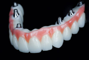 all on 6 dental implants with a full arch on top of it