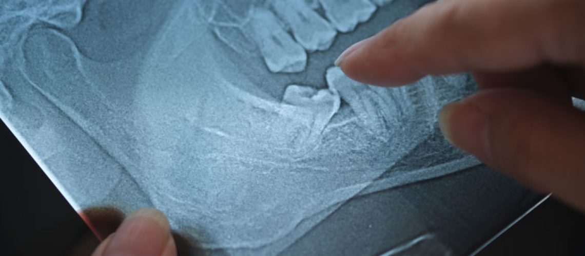 Panoramic x-ray image of teeth and mouth with wisdom teeth, wisdom teeth need to be removed based on the position of the tooth in the xray