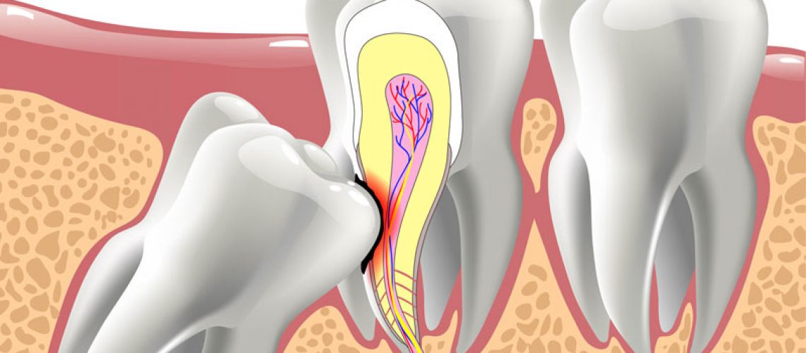 2d image showing how harmful wisdom teeth can be if not removed