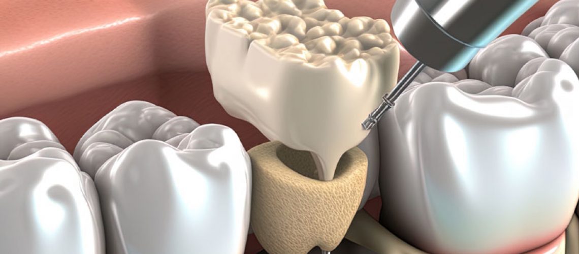 3d image of a dental implant