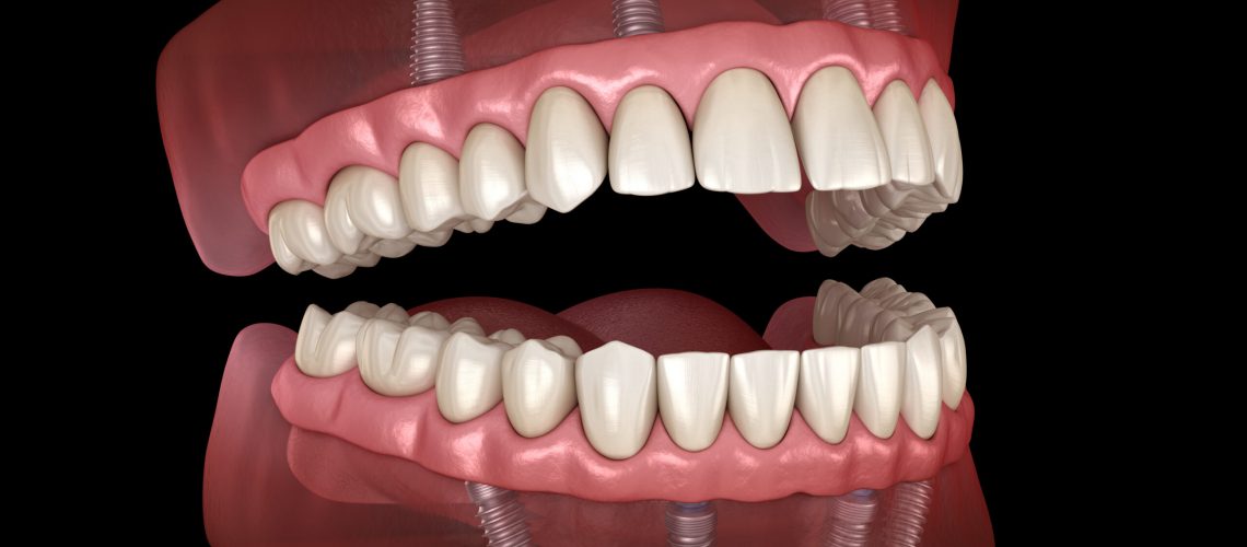 a 3D image of dental implants in Monroeville, PA.
