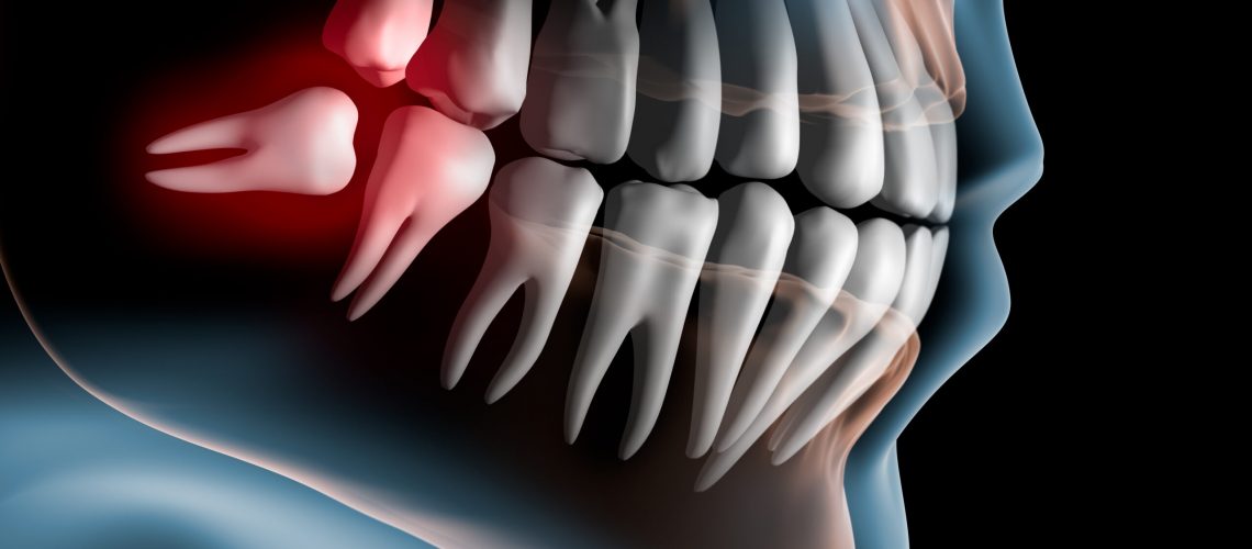 xray model of a problematic wisdom tooth