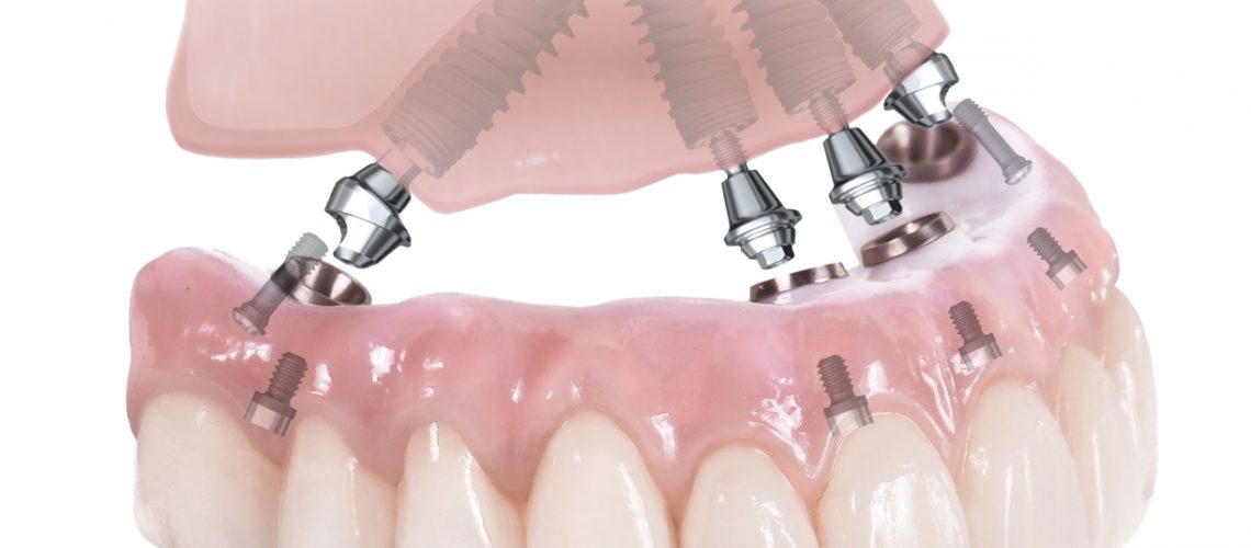 An image of a All-On-4 dental implant model.