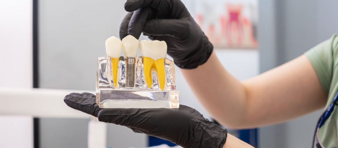 Dental expert holding human teeth model, pointing to the crown of a dental implant, and offering advice on dental implant maintenance and healthy teeth care.