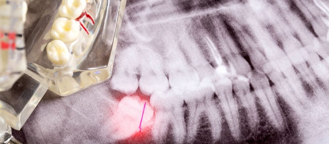 This image shows an X-ray of teeth with a highlighted wisdom tooth at the bottom left. A dental model is also partially visible.
