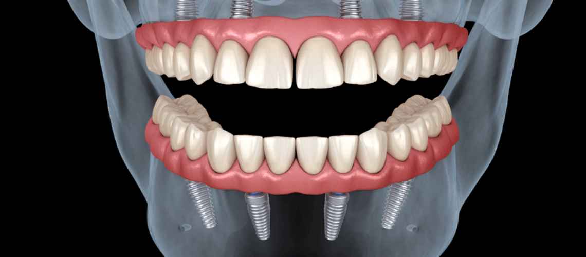 an image of a facial skeleton with All-On-4 dental implants fixed in its mouth.