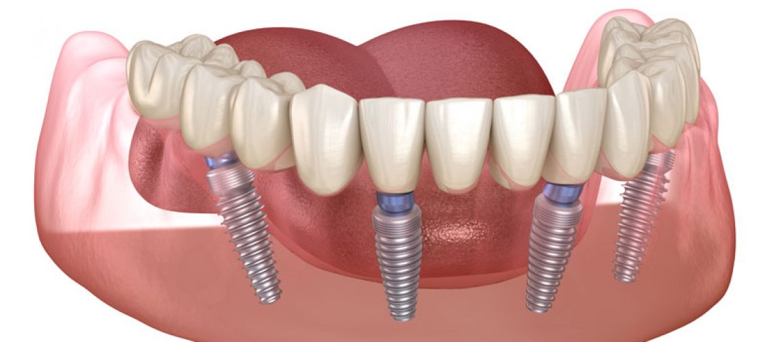 image of an all-on-4 dental implant model