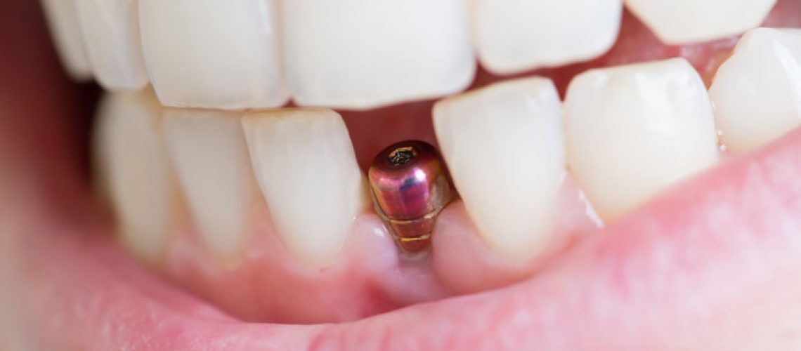 Dental Implant Post In A Dental Patient's Lower Front Jaw