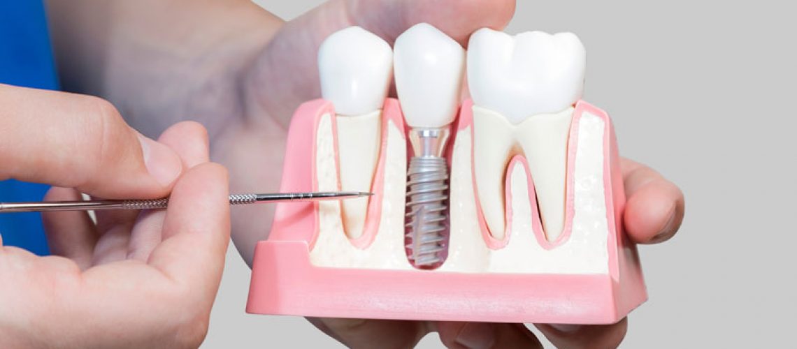 Dental Assistant Showing Off A Dental Implant In A Jawbone Cutaway Model in Mt. Pleasant, PA