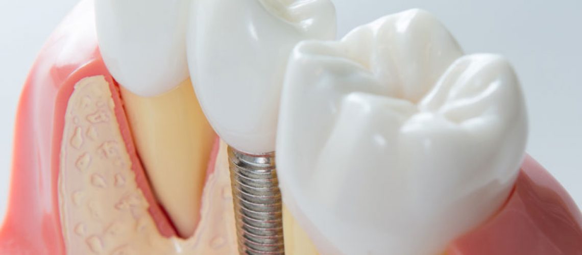 3d model of a dental implant