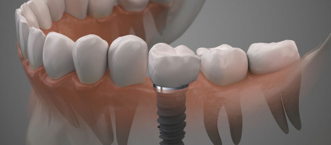 Dental Implant Graphic