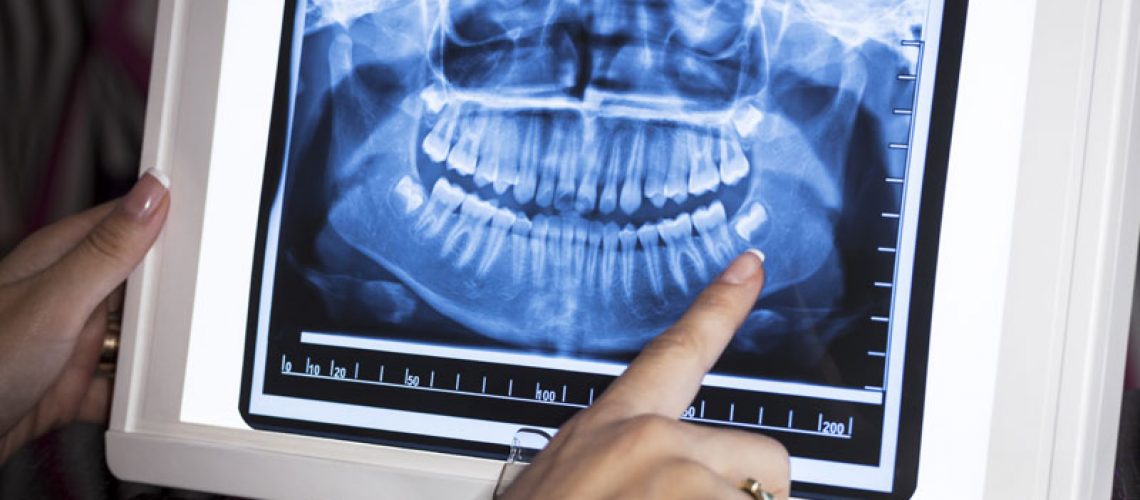 Dental XRay Diagram