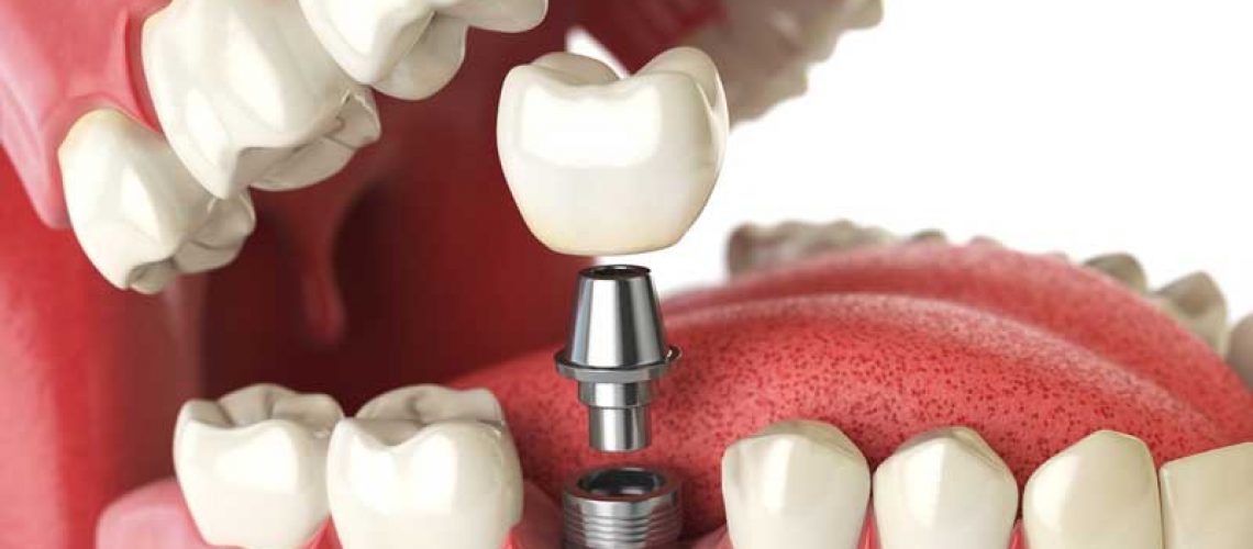 graphic of a dental implant being placed