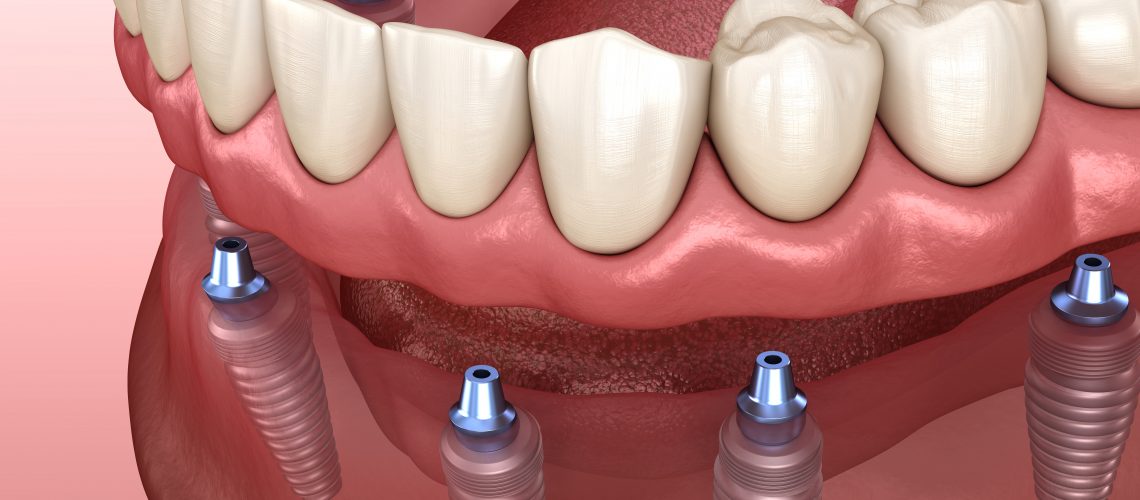 an implant supported dentures model showing how implant supported dentures use dental implants to secure a denture in place.