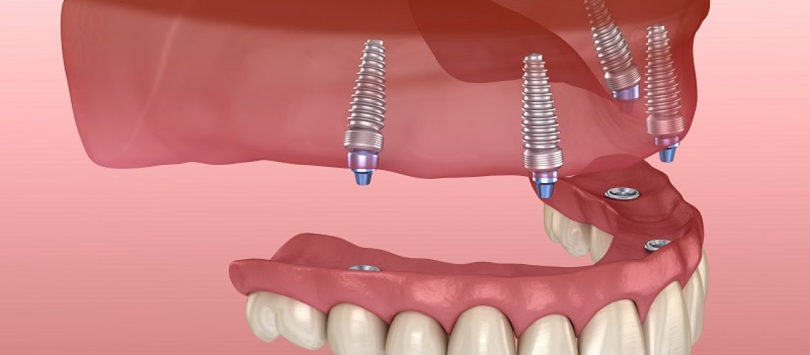 implant supported dentures pittsburgh pa