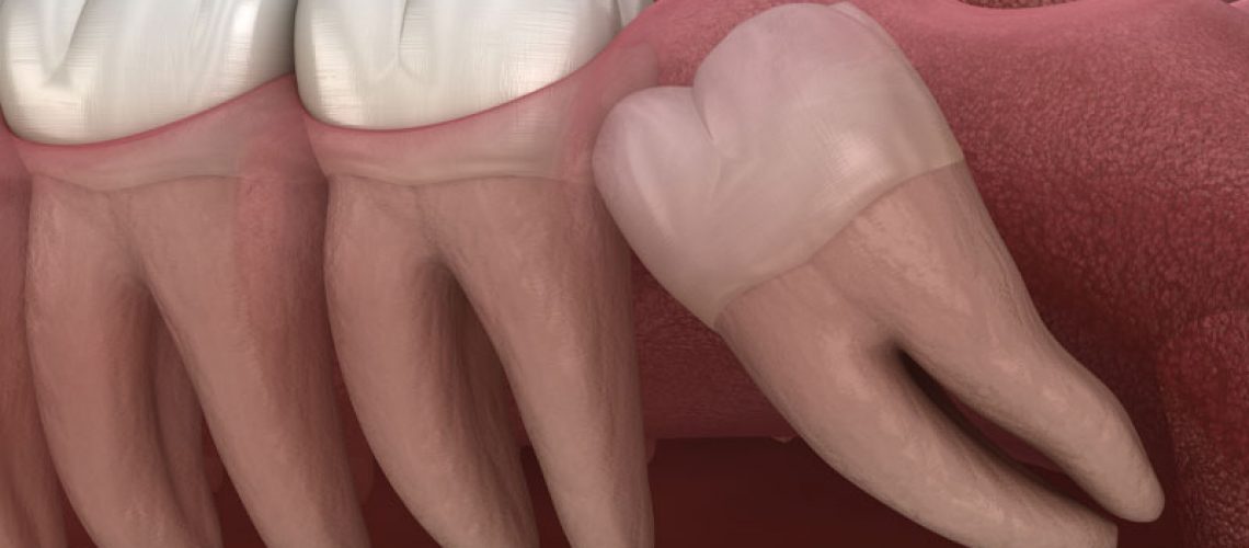 Impacted Wisdom Tooth Graphic