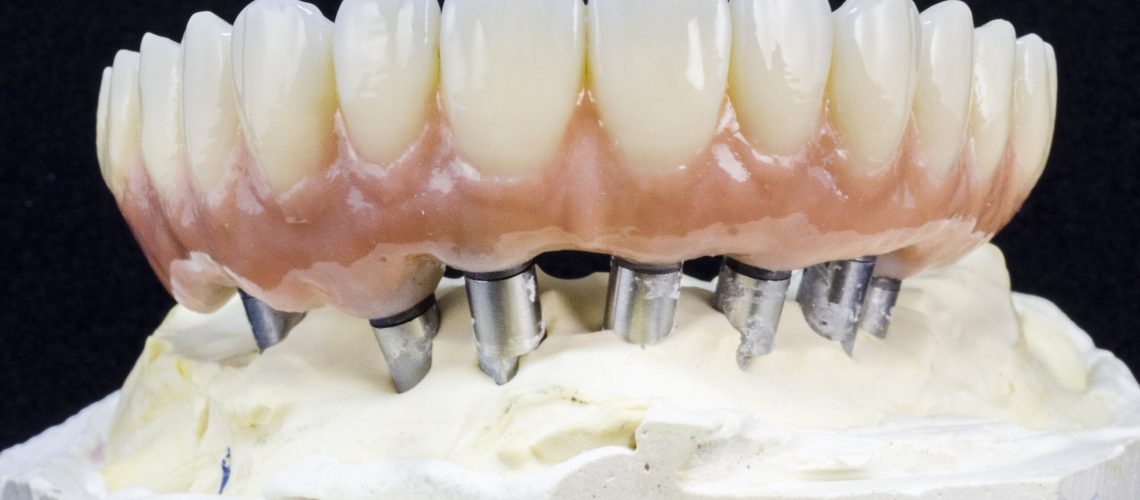 implant supported denture model.