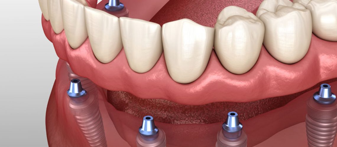 implant supported dentures on the lower arch
