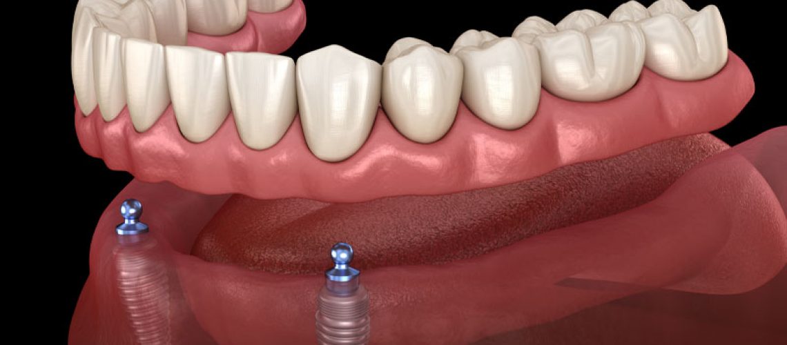 a digital implant of a lower arch with an implant supported denture being attached by multiole dental implants.