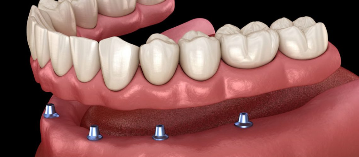 an implant supported dentures model showing how the dental implant posts and denture can be predictably placed following additional restorative procedures.