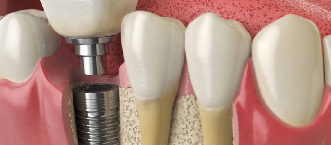 model of a placed dental implant