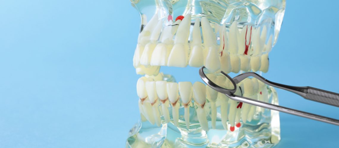 full mouth dental implant with clear jaw prosthesis