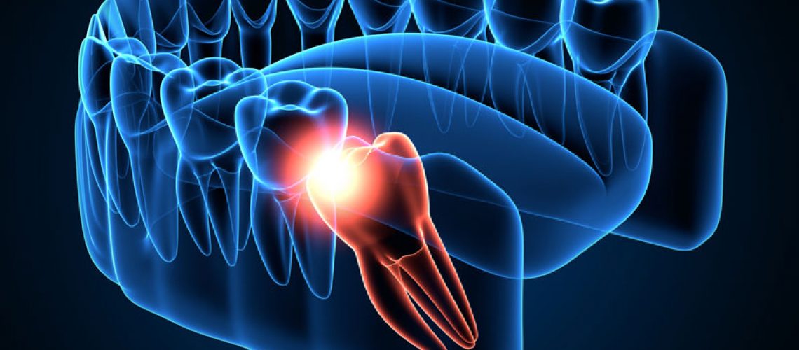 wisdom tooth visualization showing a wisdom tooth impacting a molar causing pain highlighted in red