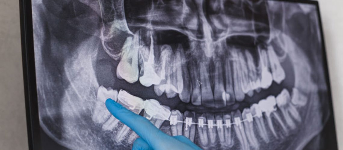 an image of an impacted wisdom tooth.